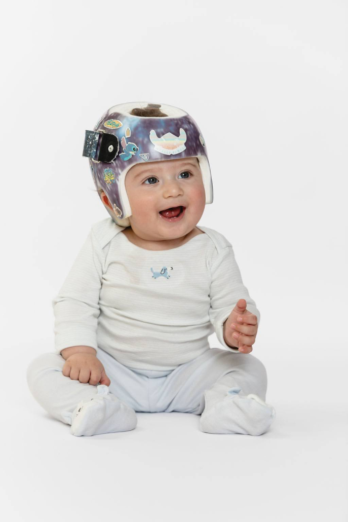 plagiocephaly
